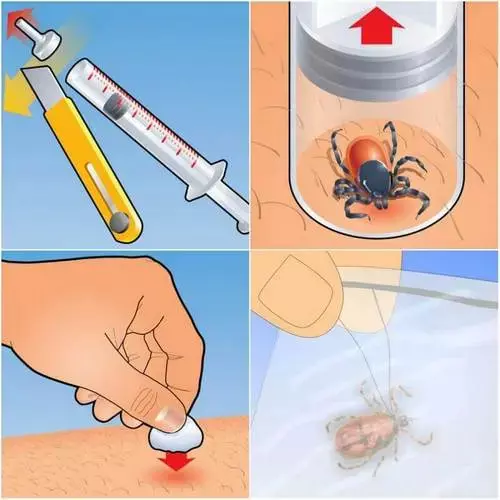 Udalenie Kleshha Shpritsom