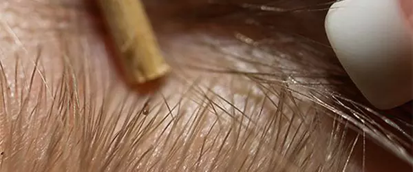 Vshy U Detej Kak Poyavlyayutsya Y Kak S Nymy Borotsya 4